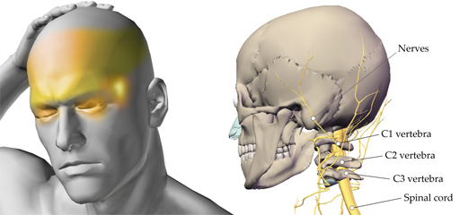 Cervicogenic Headaches