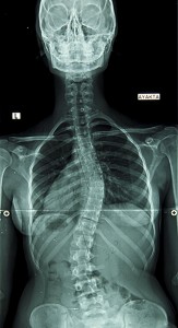 A new type of Scoliosis – Adult Onset Scoliosis | Mount Albert ...